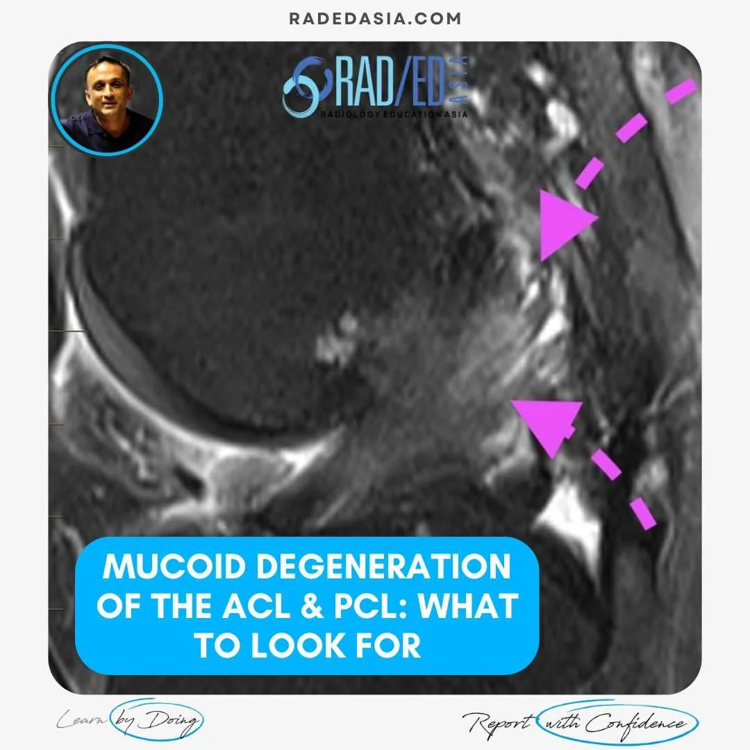 ACL & PCL MUCOID DEGENERATION MRI FINDINGS - Radiology Education Asia