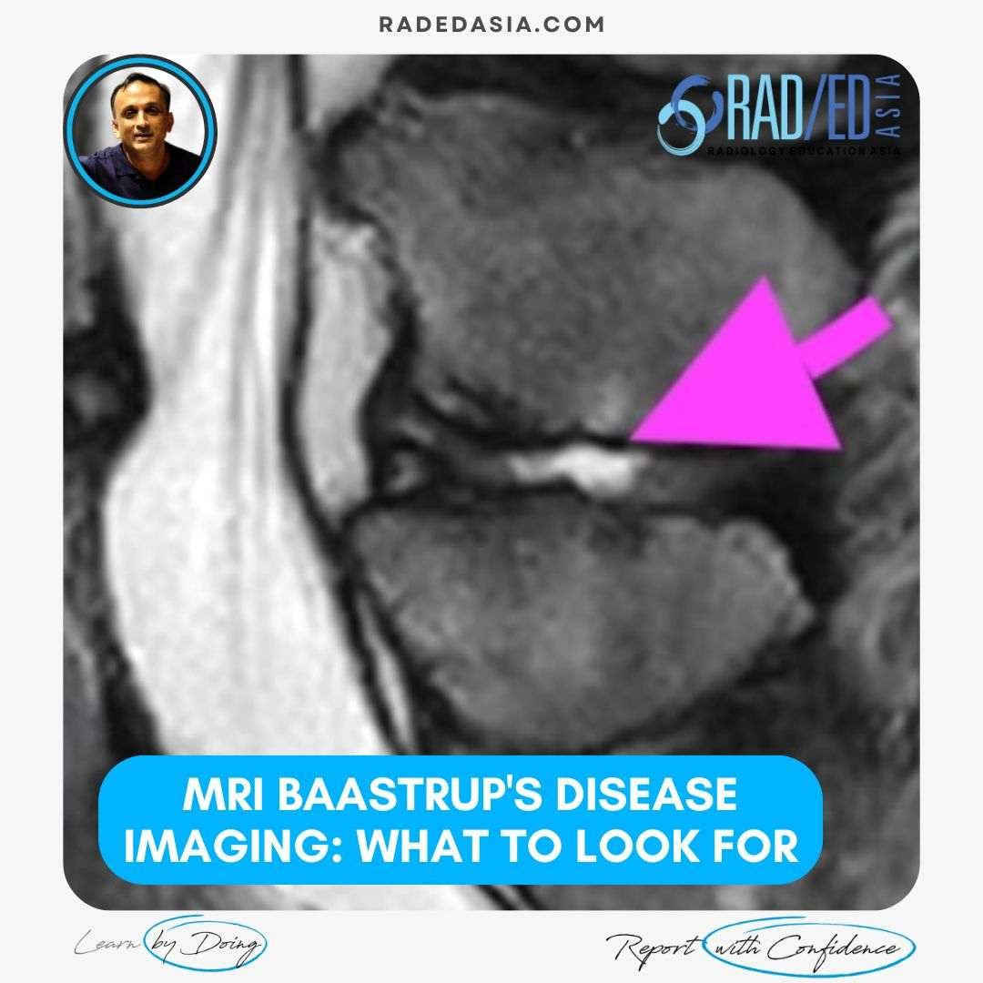 mri-baastrup's-disease-imaging-findings-what-to-look-for-radedasia