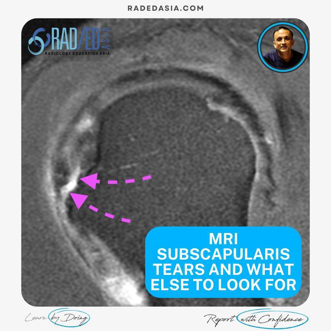 mri-subscapularis-tendon-tear-atrophy-fatty-infiltration-biceps-subluxation-dislocation-radedasia