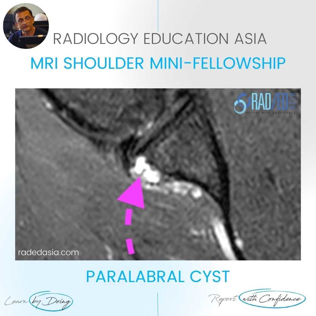 paralabral cyst shoulder labrum mri radedasia