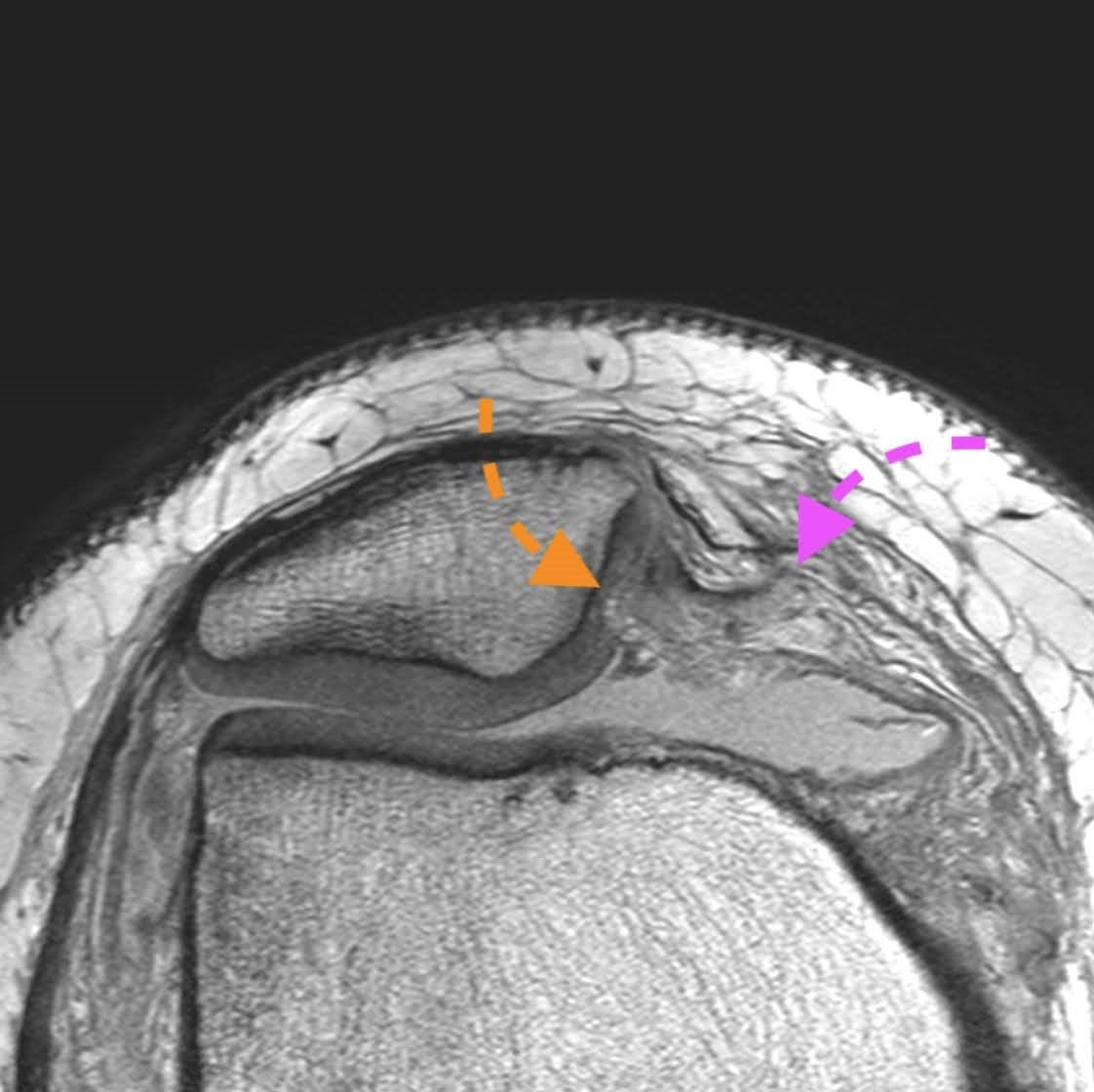 CTMRISP MSK MRI KNEE ONLINE GUIDED MINI FELLOWSHIP - Radiology ...