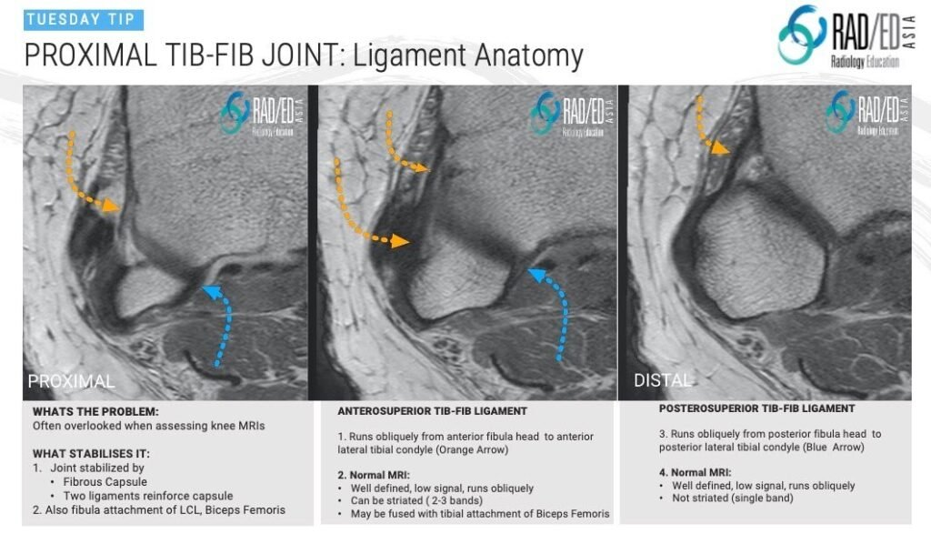 MRI KNEE ANATOMY: PROXIMAL TIBIOFIBULAR JOINT - Radiology Education Asia