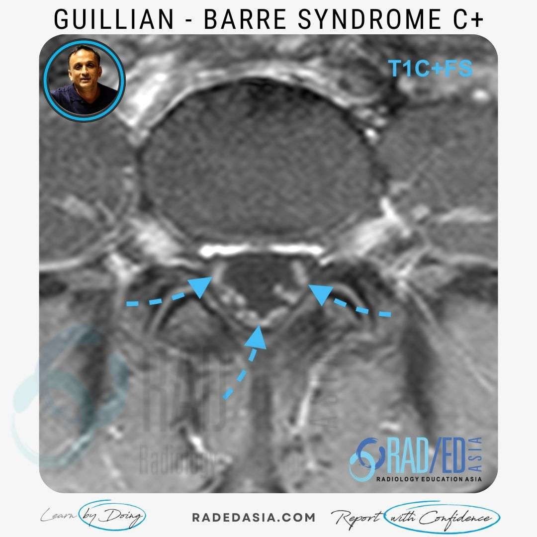 MRI FINDINGS IN GUILLIAN BARRE SYNDROME Radiology Education Asia