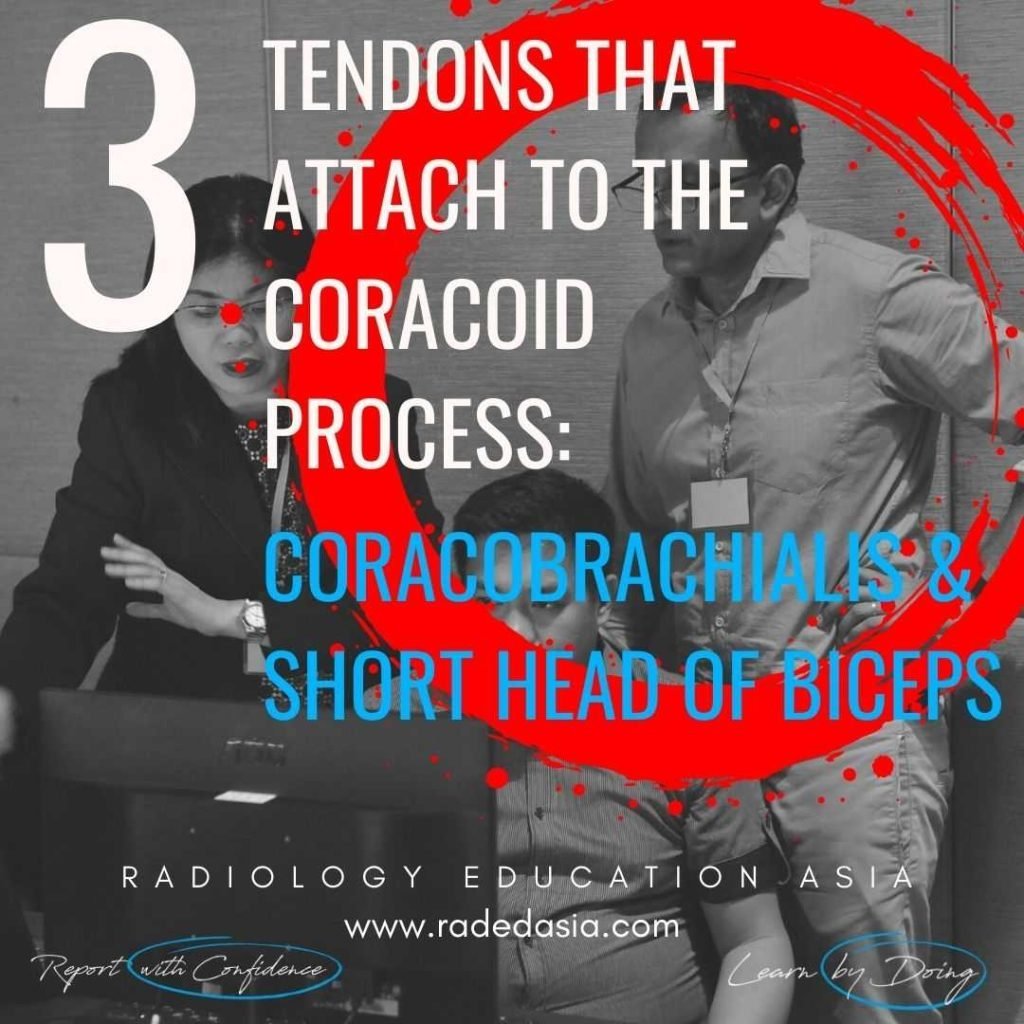 Coracoid process attachment of the conjoint tendon formed by the coracobrachialis and short head of the biceps