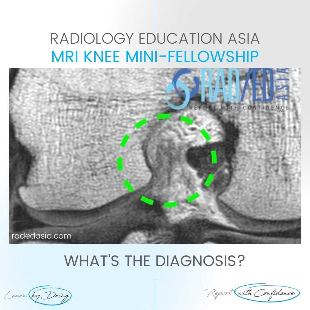 acl-tear-mri-findings-knee-full-thickness-coronal-radiology-radedasia.jpg