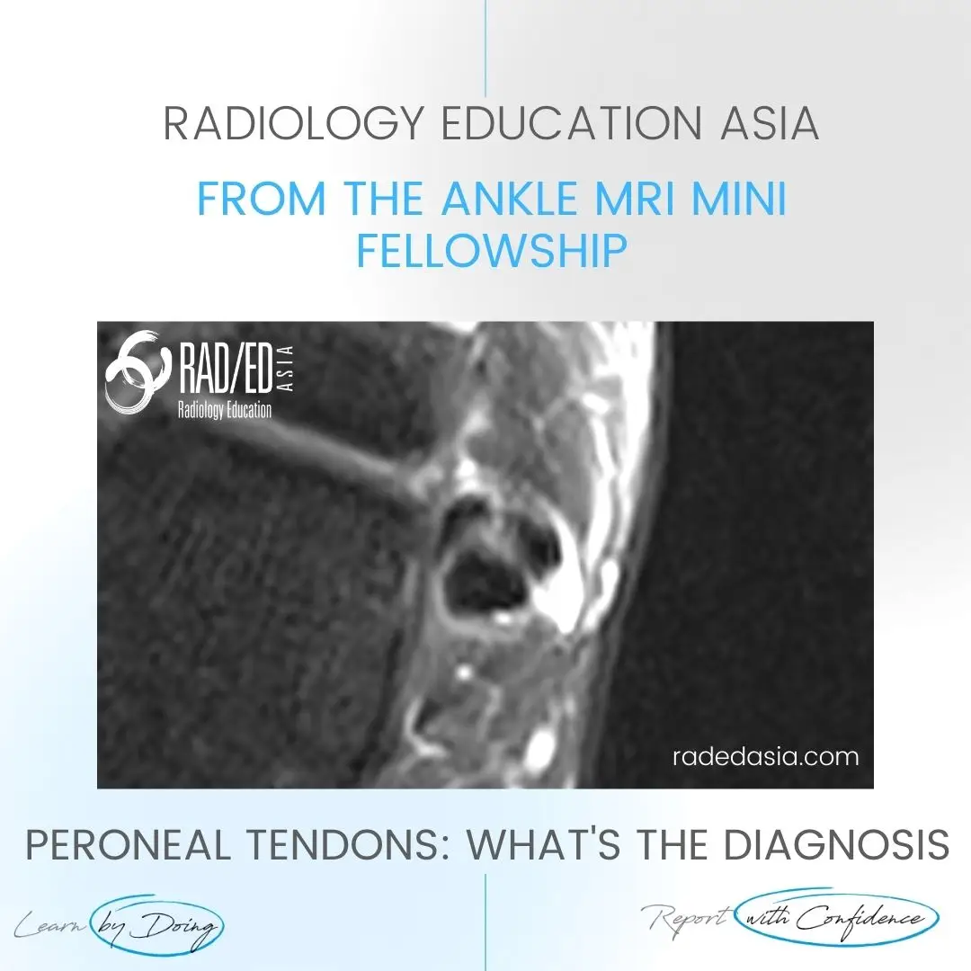 ankle-mri-peroneus-brevis-tendon-tear-split.jpg