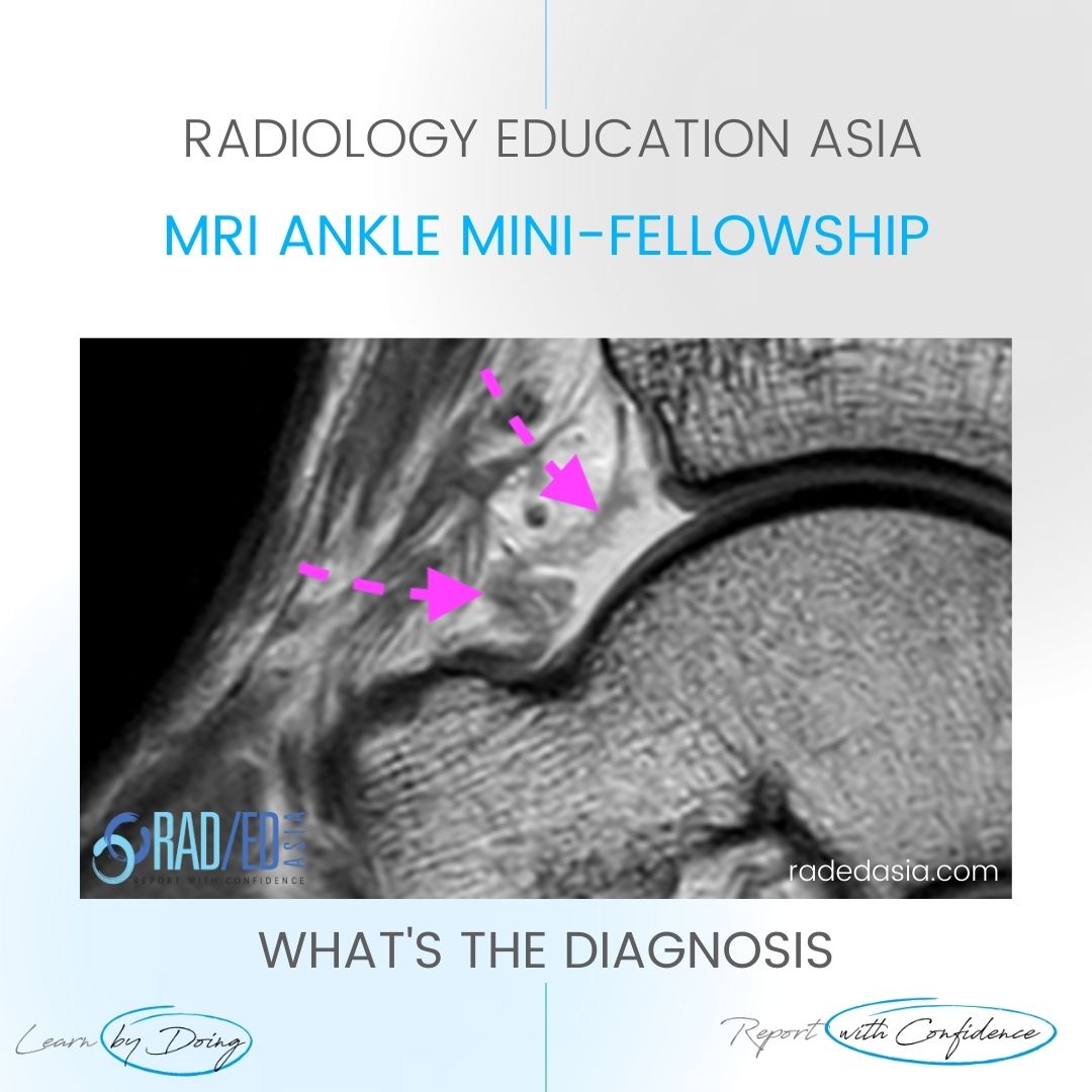 ankle-mri-synovitis-capsulosynovitis.jpg