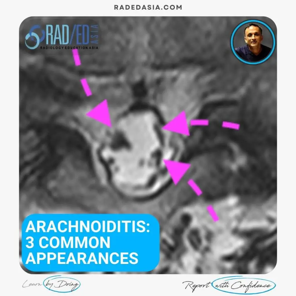 arachnoiditis spine mri online radiology lumbar cord