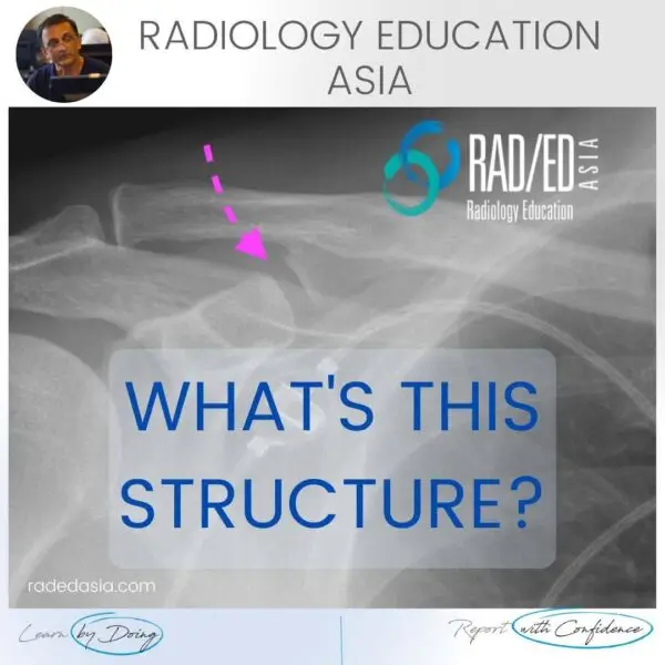 coracoclavicular-joint-shoulder-normal-variant-xray