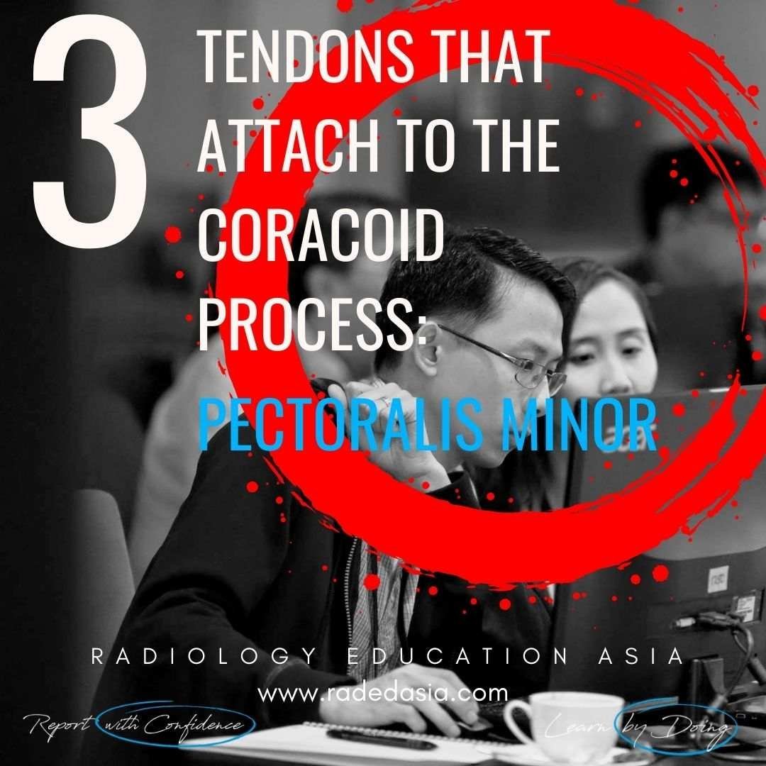 Coracoid process tendon attachments, including the pectoralis minor insertion and key anatomical landmarks.