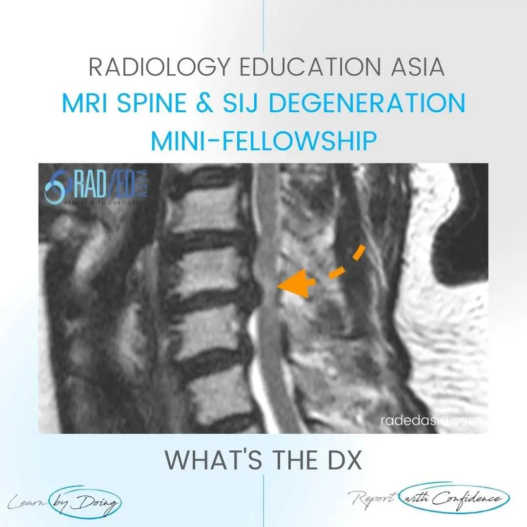 cord-signal-change-spondylotic-myelopathy-mri.jpg