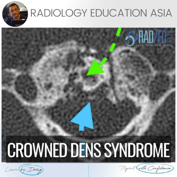 cppd-crowned-dens-spine-mri-ct-online-radiology-course-calcium-pyrophosphate-deposition-radedasia