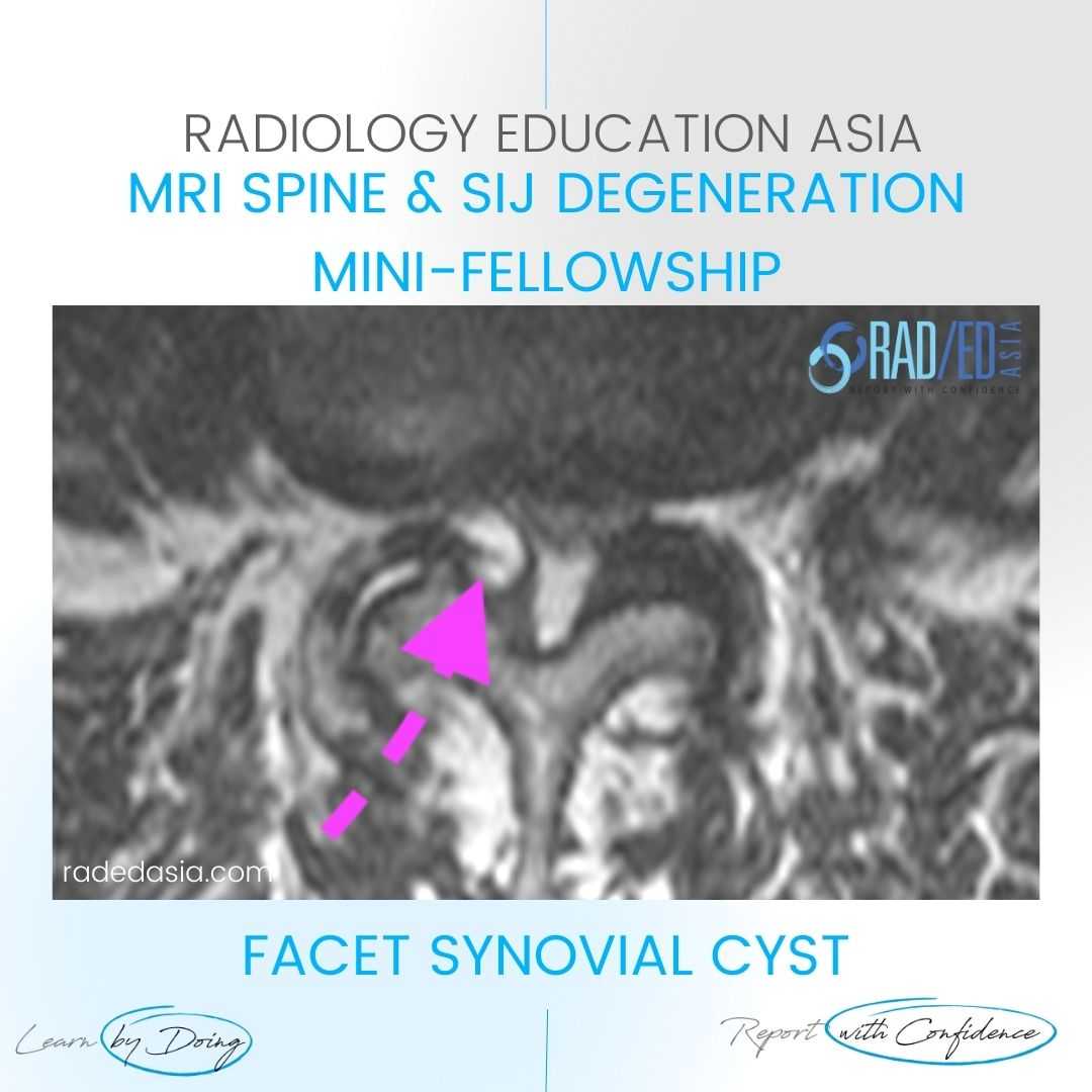 facet-synovial-cyst-radiology-mri-lumbar-spine.jpg