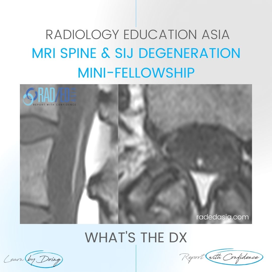 fatty-filum-mri-learn-spine-radiology.jpg