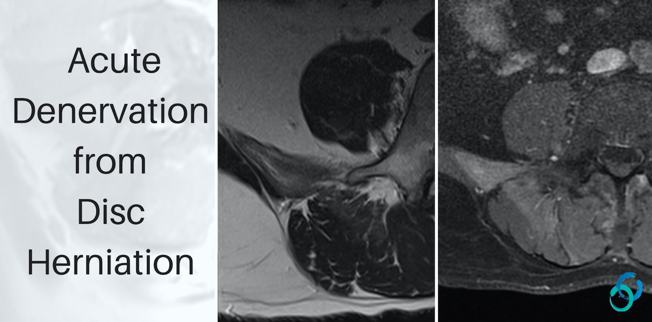 denervation lumbar mri paraspinal