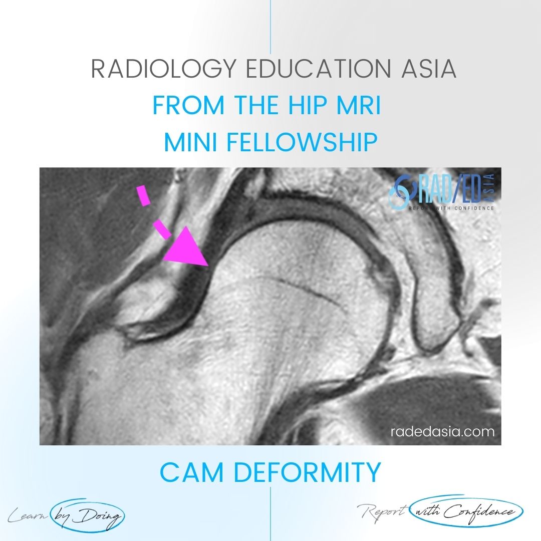 hip-mri-cam-fai-femoro-acetabular-impingement-rea.jpg