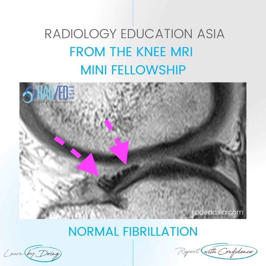 learn-knee-mri-normal-fibrillation-radedasia.jpg