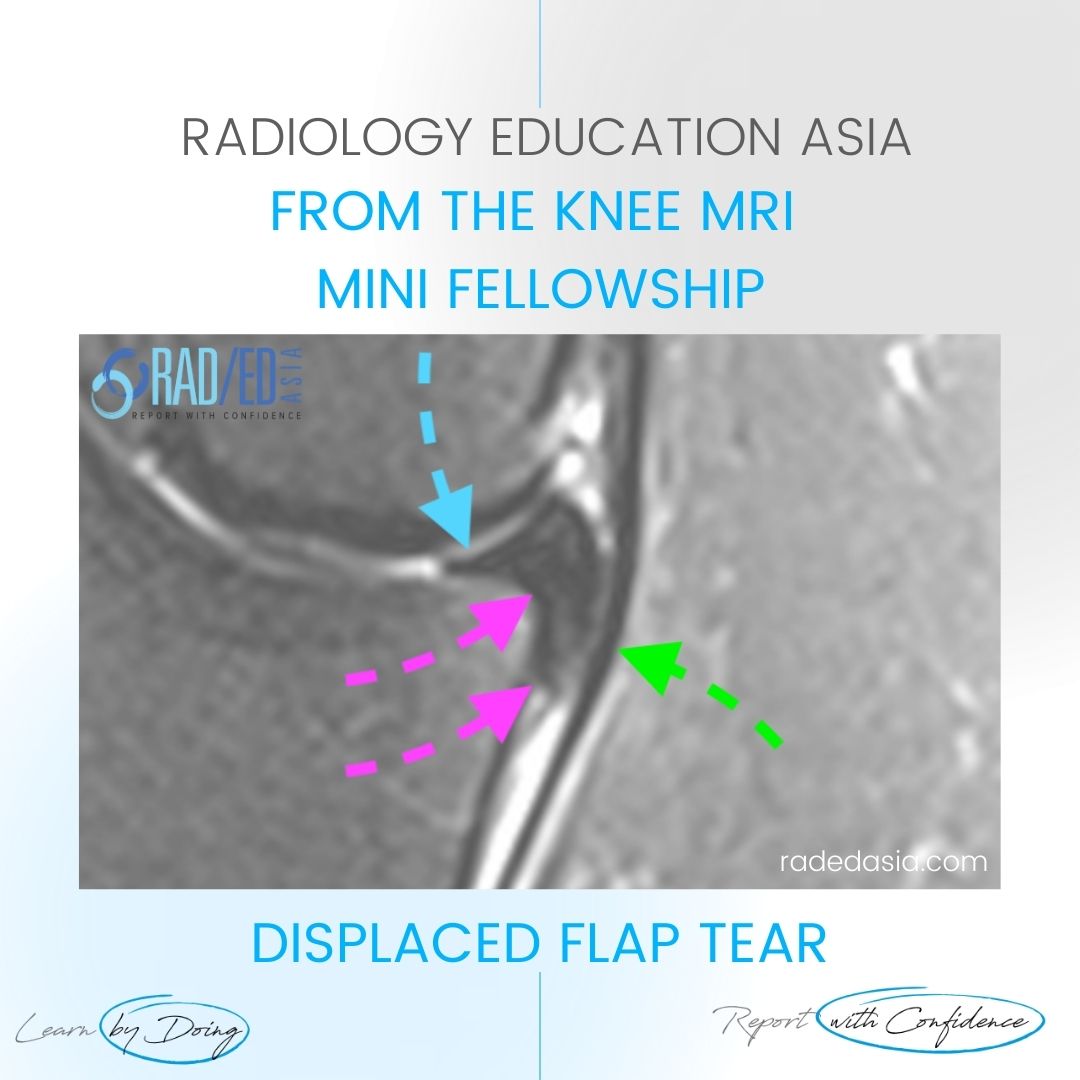 learn-mri-knee-meniscus-disp-flap-tear-dx-radedasia.jpg