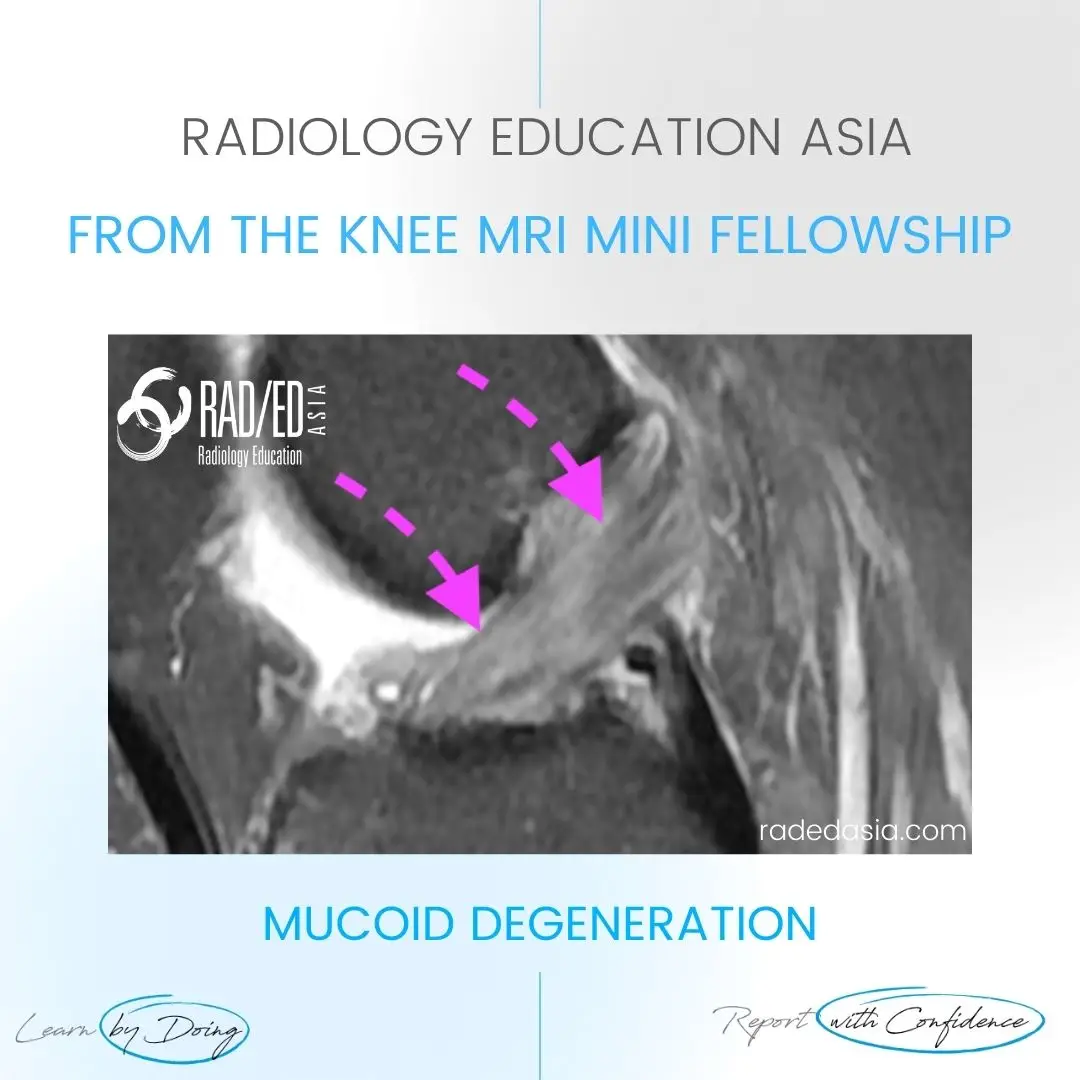 learn-mri-knee-mucoid-degen-diag-radedasia.jpg