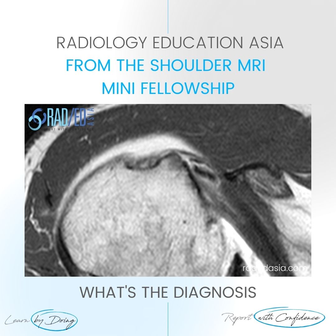 learn-shoulder-mri-biseps-disloc-cyst-radedasia.jpg