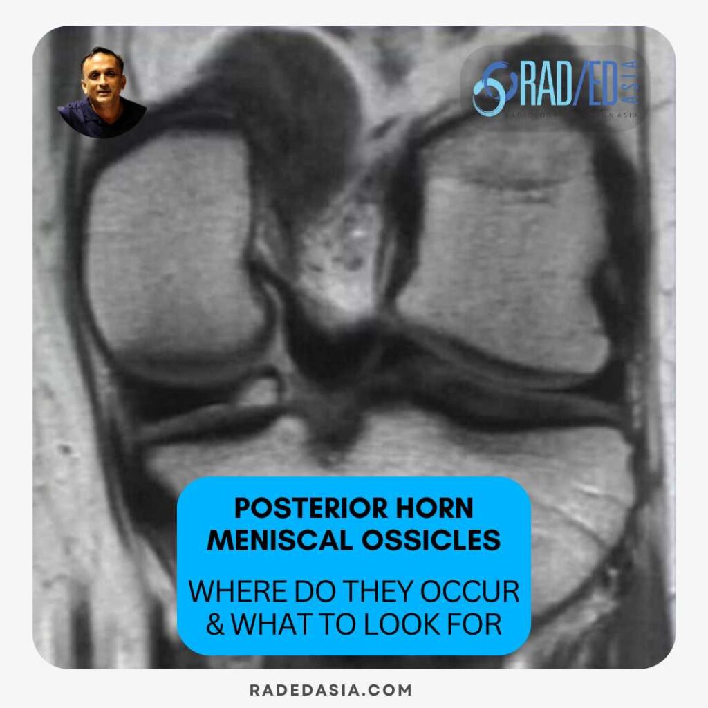 meniscal-ossicles-posterior-horn-meniscus-knee-mri-radedasia