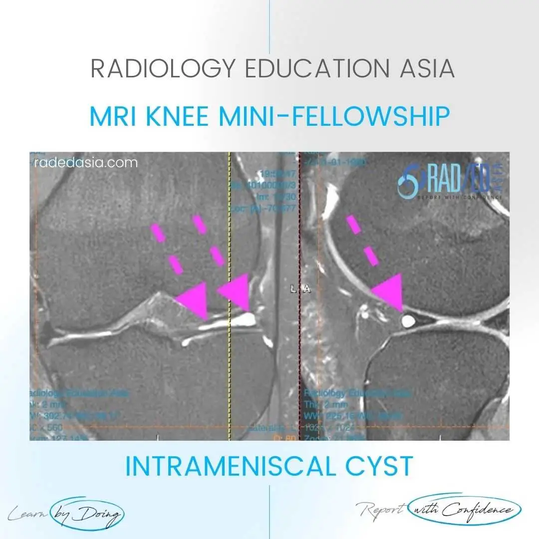 meniscus-cyst-intrameniscal-radiology-tear-mri-knee.jpg