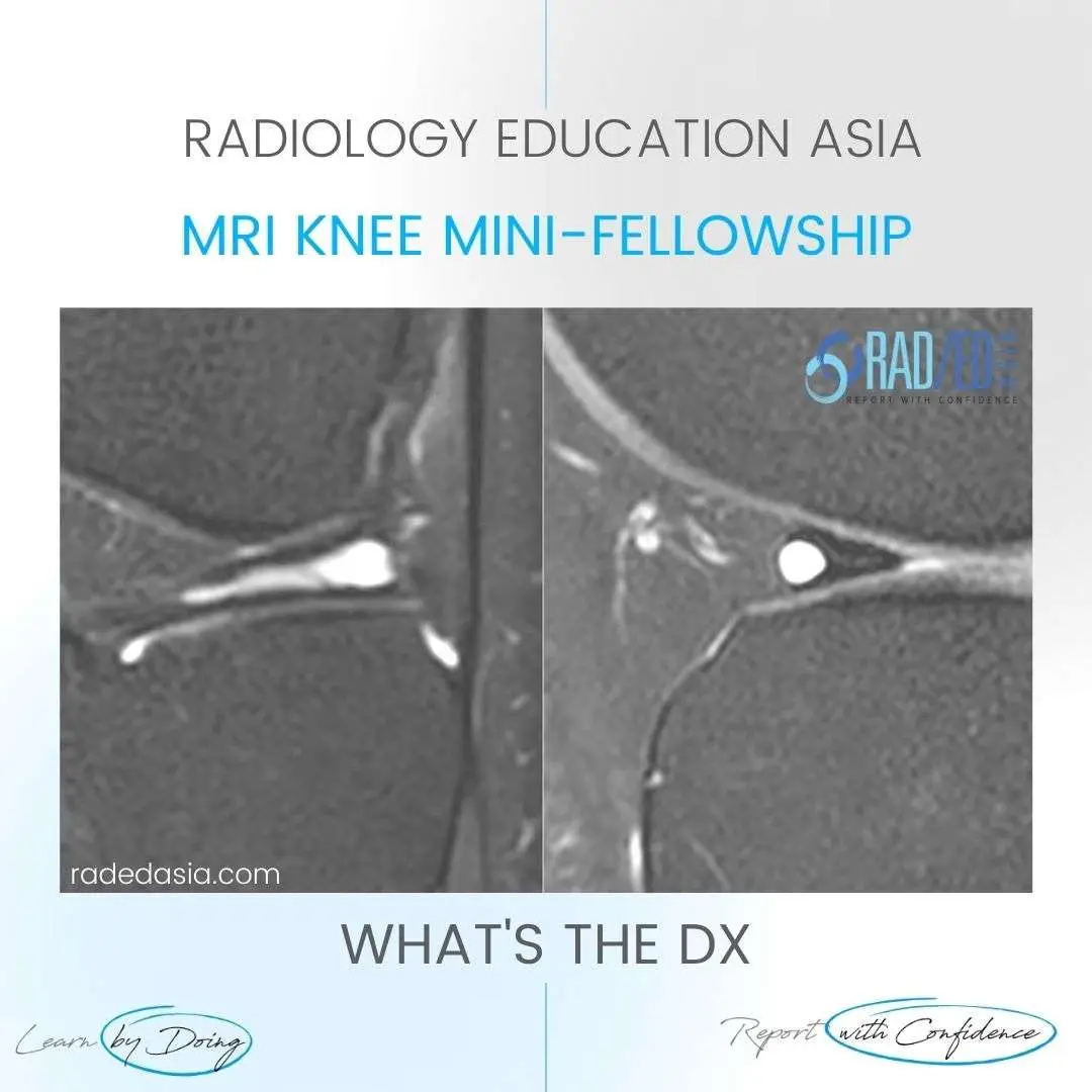 meniscus-cyst-radiology-intrameniscal-tear-mri-knee.jpg