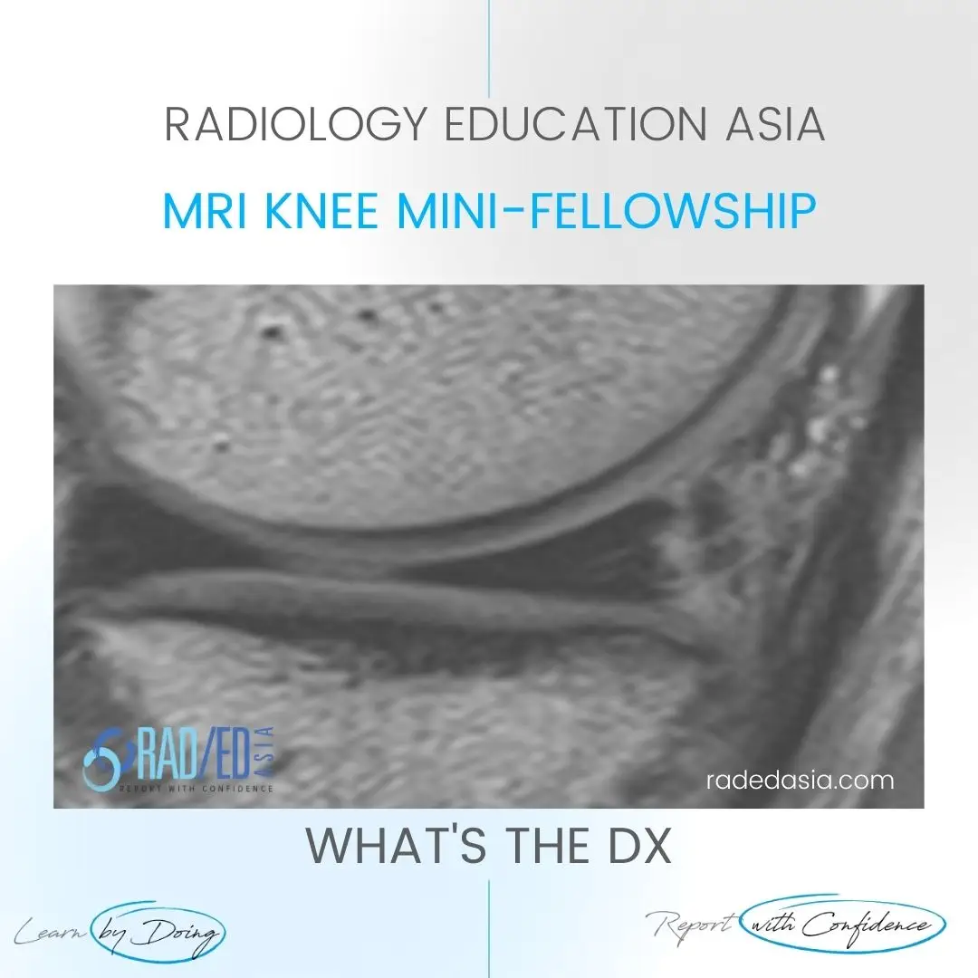 meniscus-tear-mri-vertical-knee-radedasia.jpg