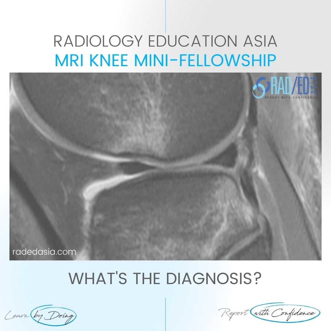 mri-acl-tear-pivot-shift-injury-bone-contusion-pattern-osteochondral-fracture-knee.jpg