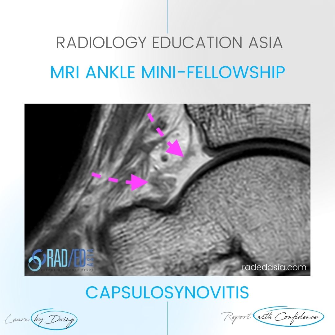 mri-ankle-synovitis-capsulosynovitis.jpg