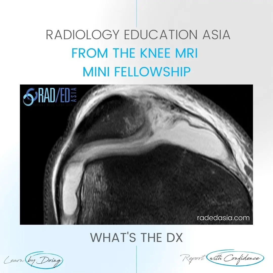 mri-knee-course-patella-dislocation.jpg