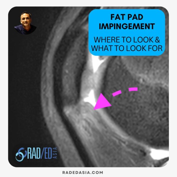 mri knee fat pad impingement radiology education asia