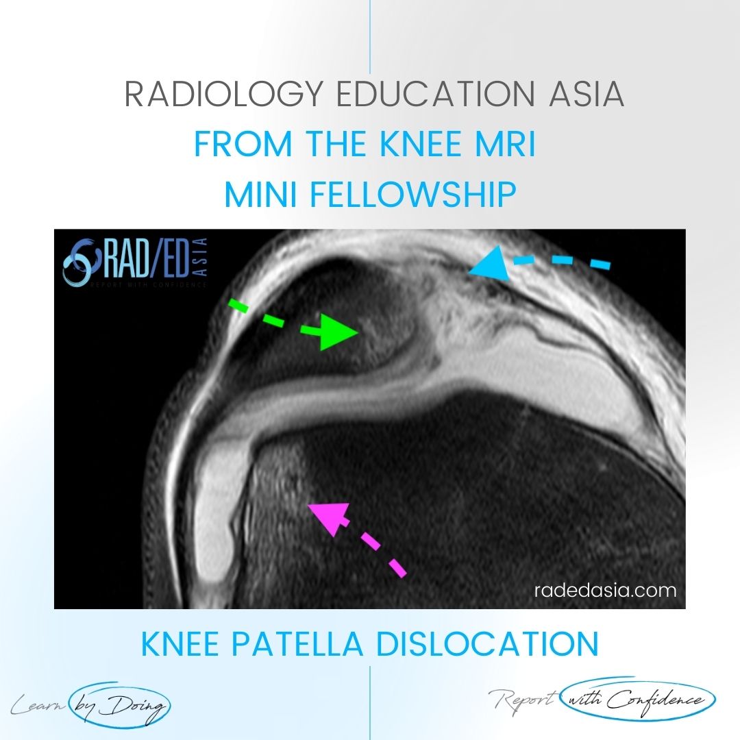 mri-patella-dislocation-learn-mri-online-dx.jpg