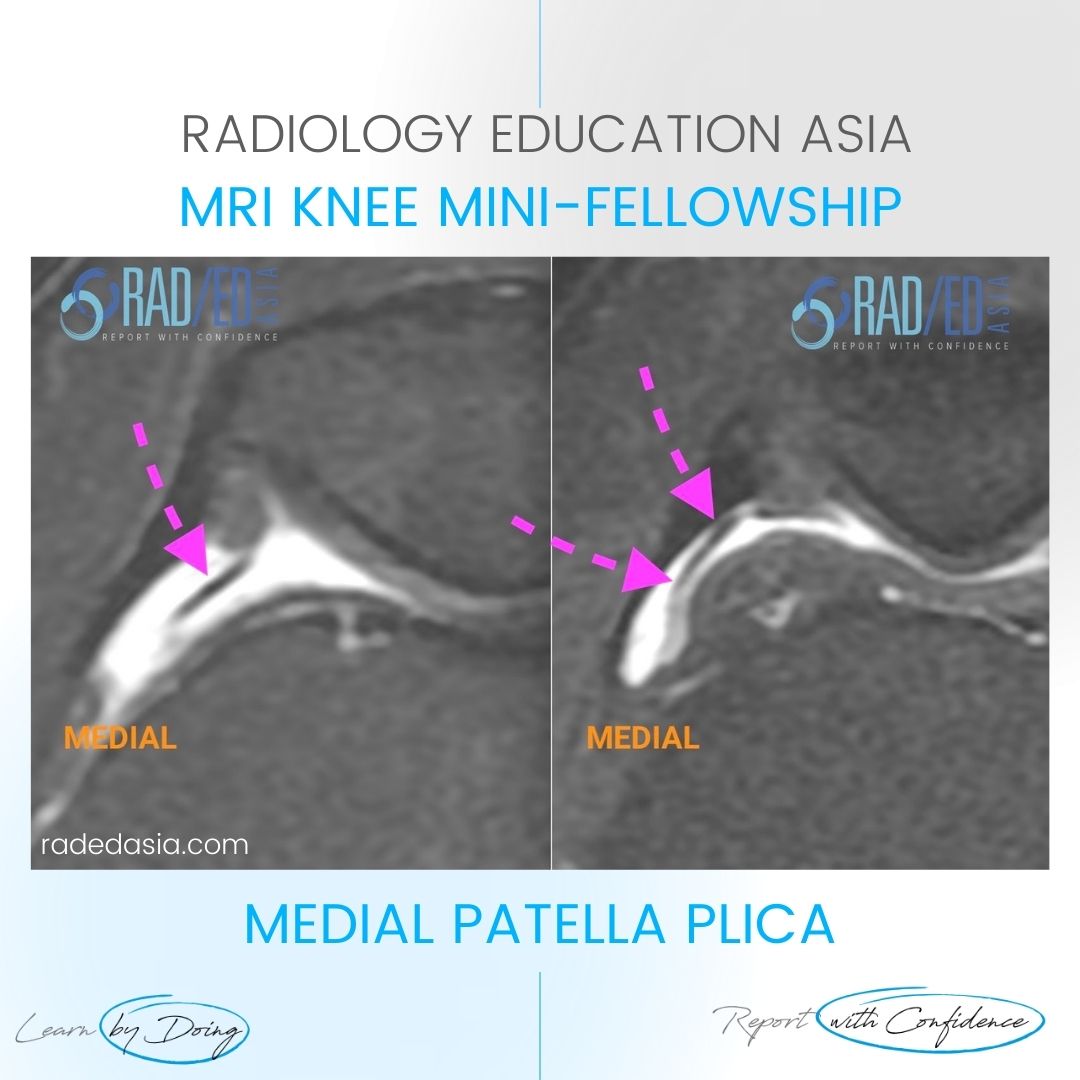 mri-patella-plica-radiology-syndrome-knee-medial-radedasia.