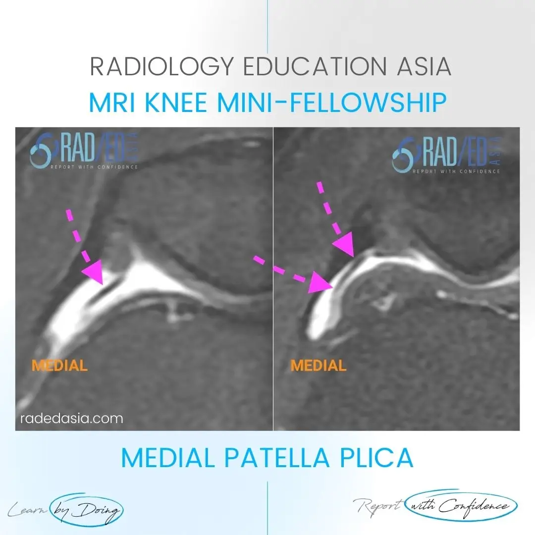 mri-patella-plica-radiology-syndrome-knee-medial-radedasia.