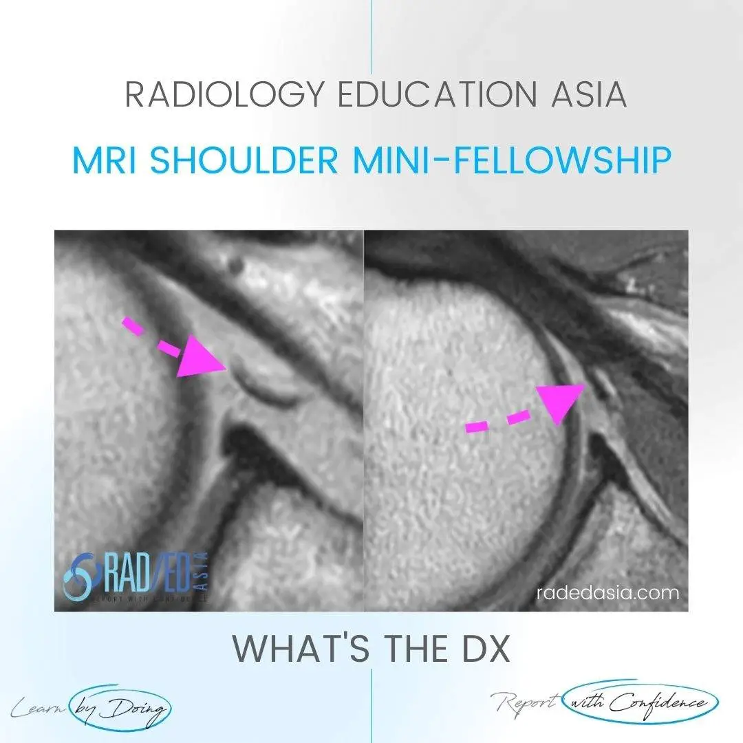 mri-shoulder-ligaments-mghl-middle-glenohumeral-ligament-radedasia.jpg