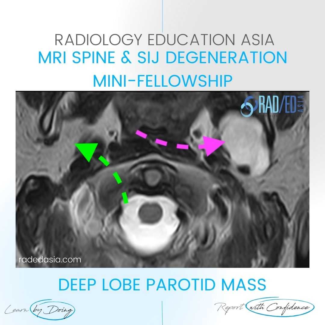 mri-spine-incidental-findings-parotid-mass.jpg