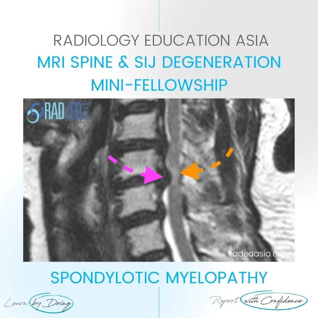 myelopathy-mri-spine-cord-signal-change-spondylotic.jpg