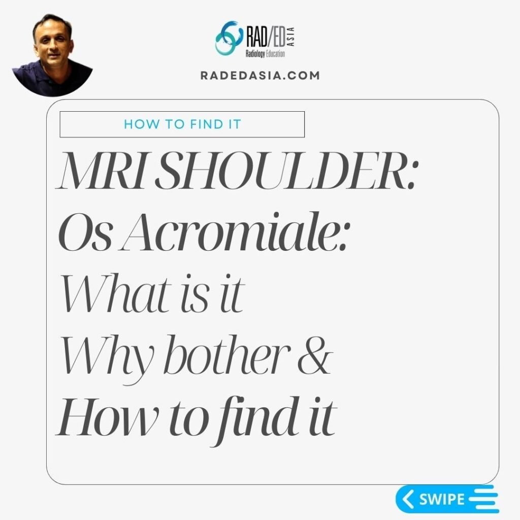 OS acromiale, its clinical significance, and how to identify this unfused acromial ossification center.