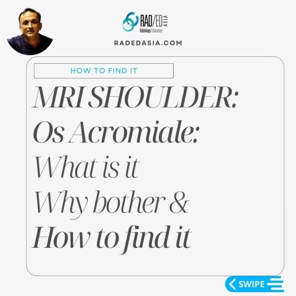 OS acromiale, its clinical significance, and how to identify this unfused acromial ossification center.