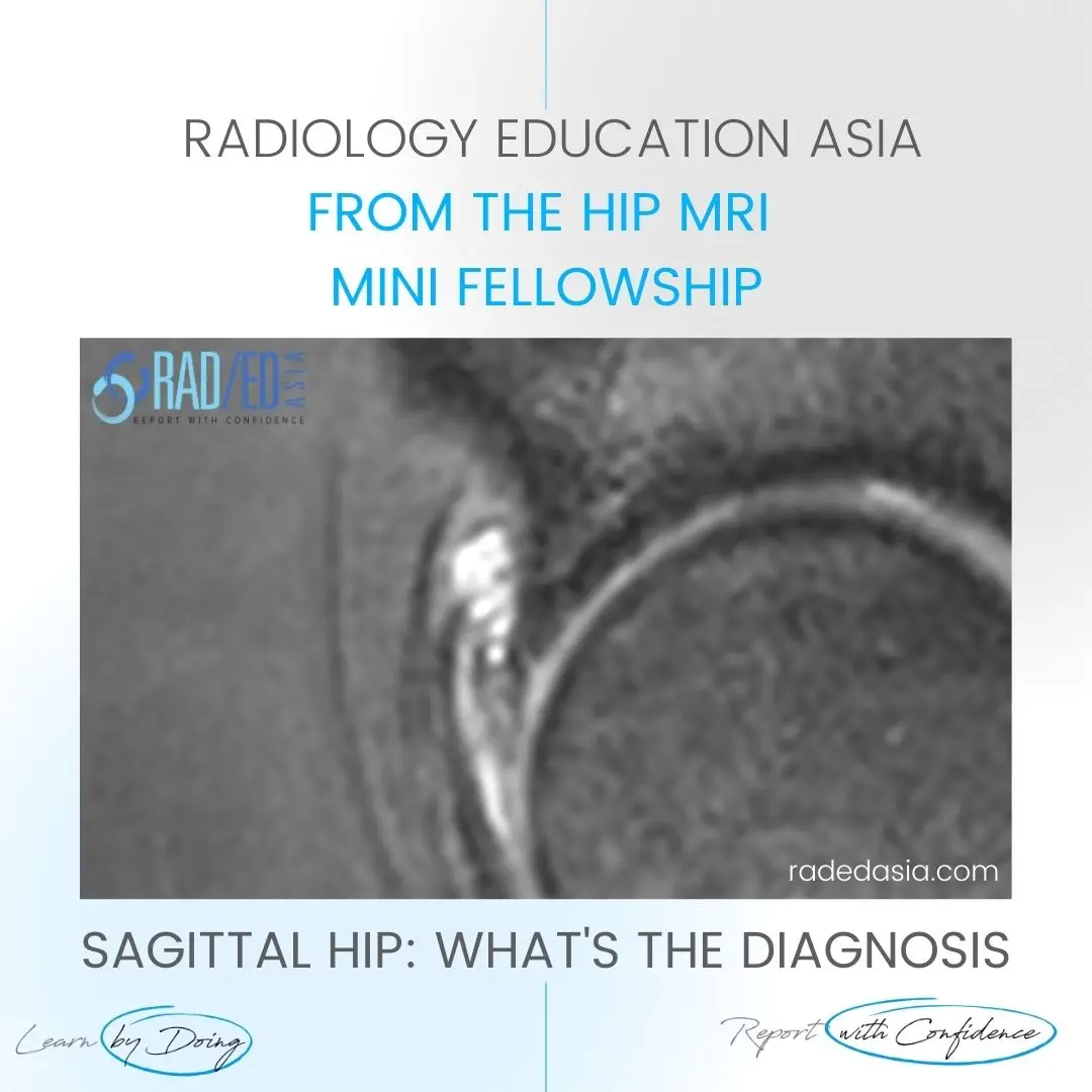 paralabral-cyst-learn-hip-labrum-tear-degeneration-radedasia.jpg