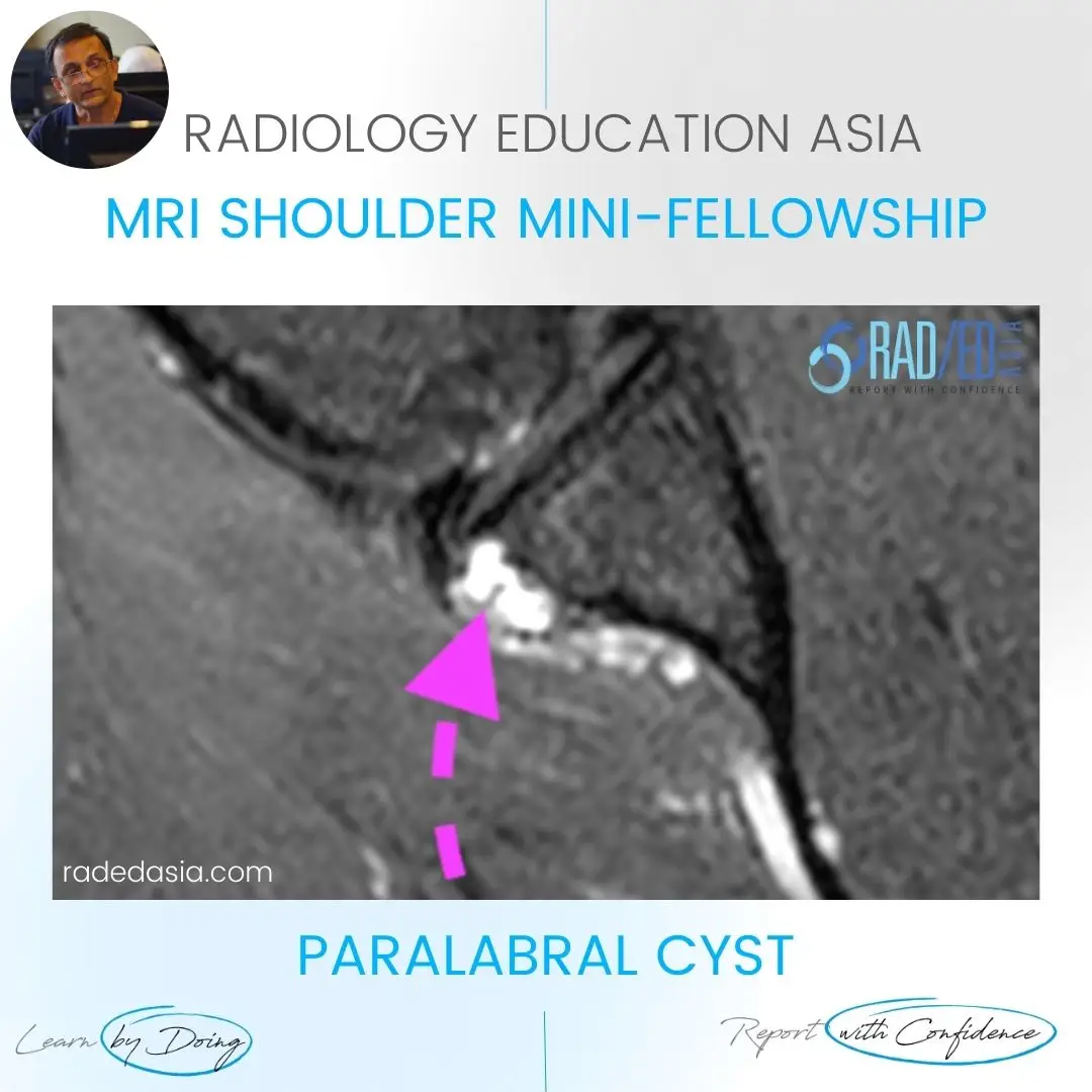 paralabral-cyst-shoulder-labrum-labrum-mri-radedasia.jpg