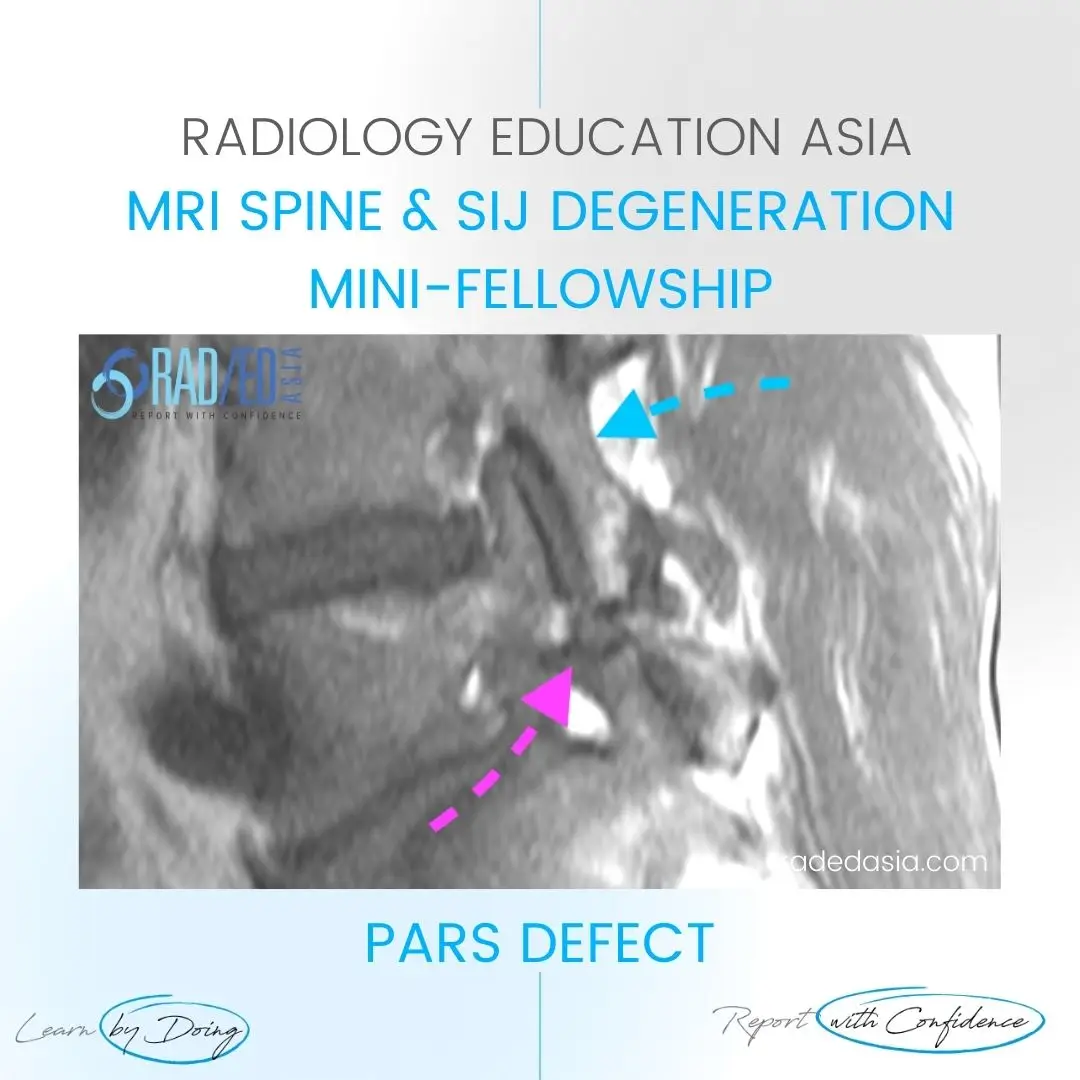 pars-defect-mri-radiology-radedasia.jpg