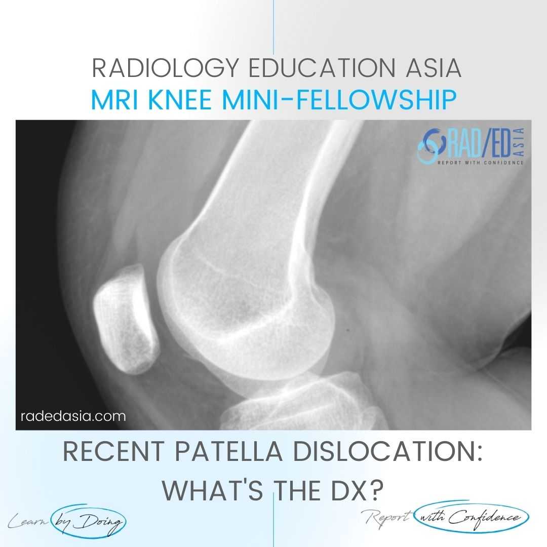 patella-dislocation-subluxation-fracture-hemarthrosis-lipohemarthrosis-radiology-mri-xray-knee.jpg