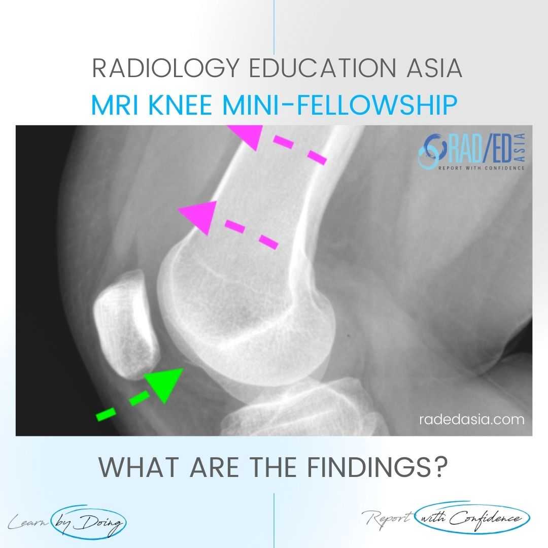 patella-subluxation-dislocation-fracture-hemarthrosis-lipohemarthrosis-radiology-mri-xray-knee.jpg