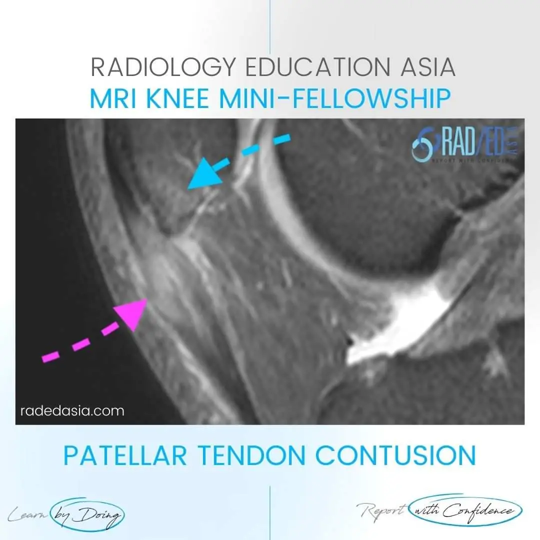 patellar-tendon-contusion-trauma-mri.jpg