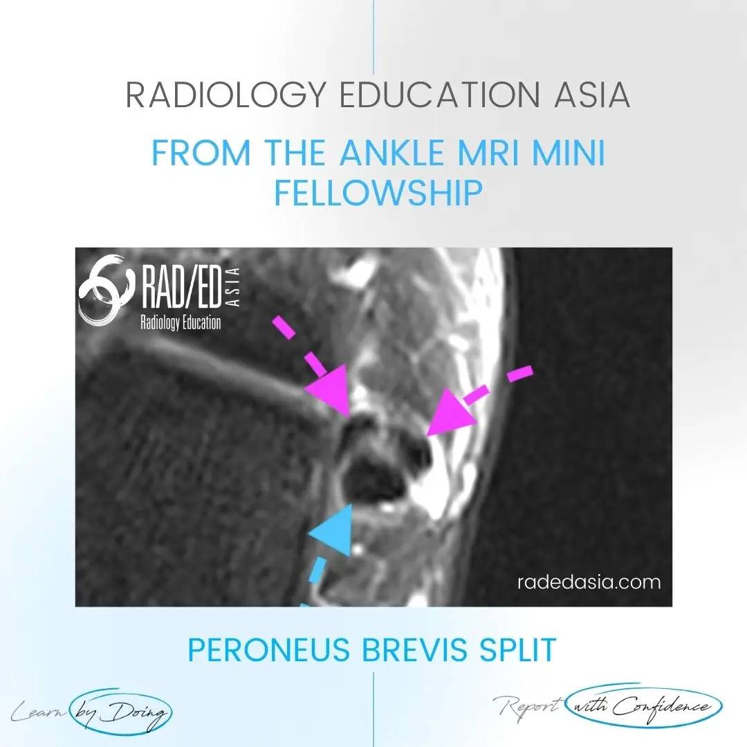 peroneus-brevis-tendon-tear-split-ankle-mri.jpg