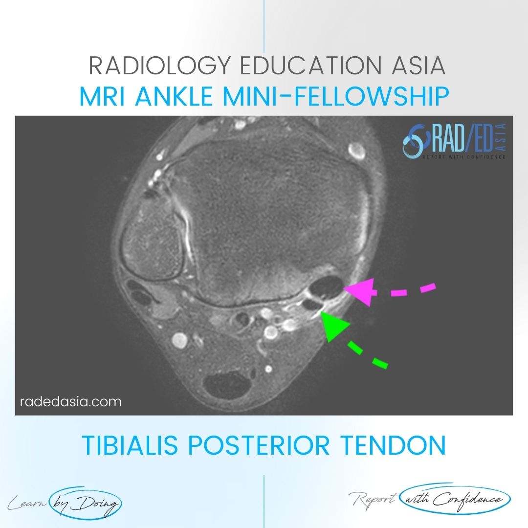 posterior-tibial-tendinopathy-mri-radiology-radedasia.jpg