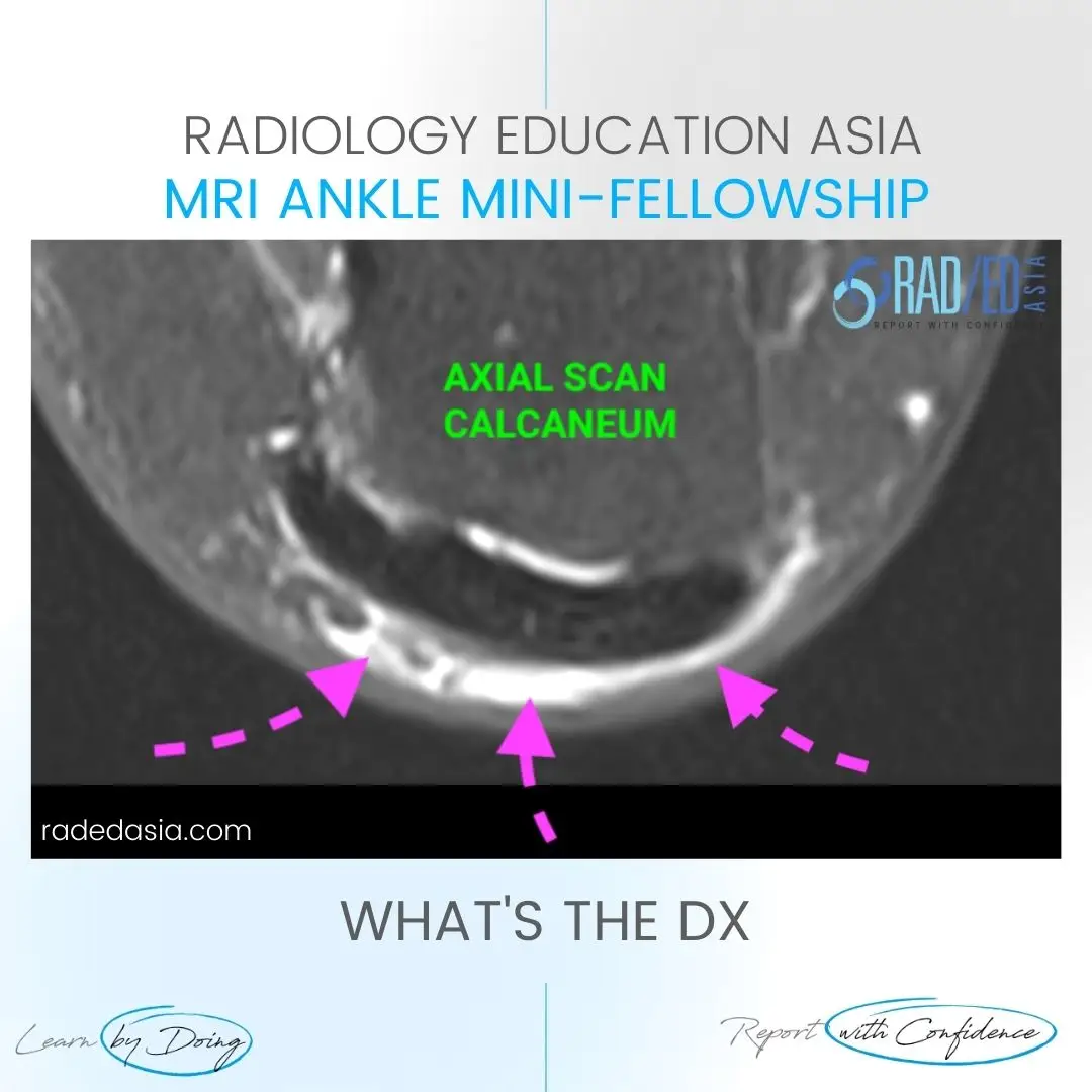 retroachilles-bursa-bursitis-mri-radiology-ankle.jpg