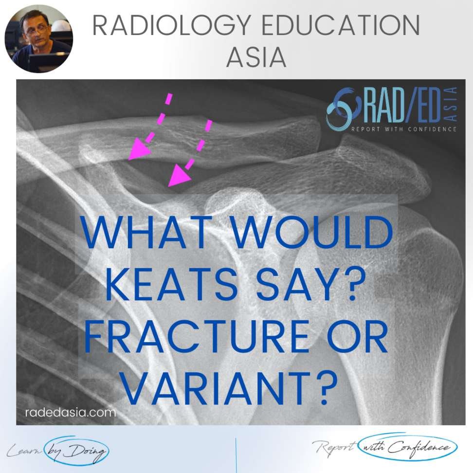 scapula normal variant keats shoulder mri